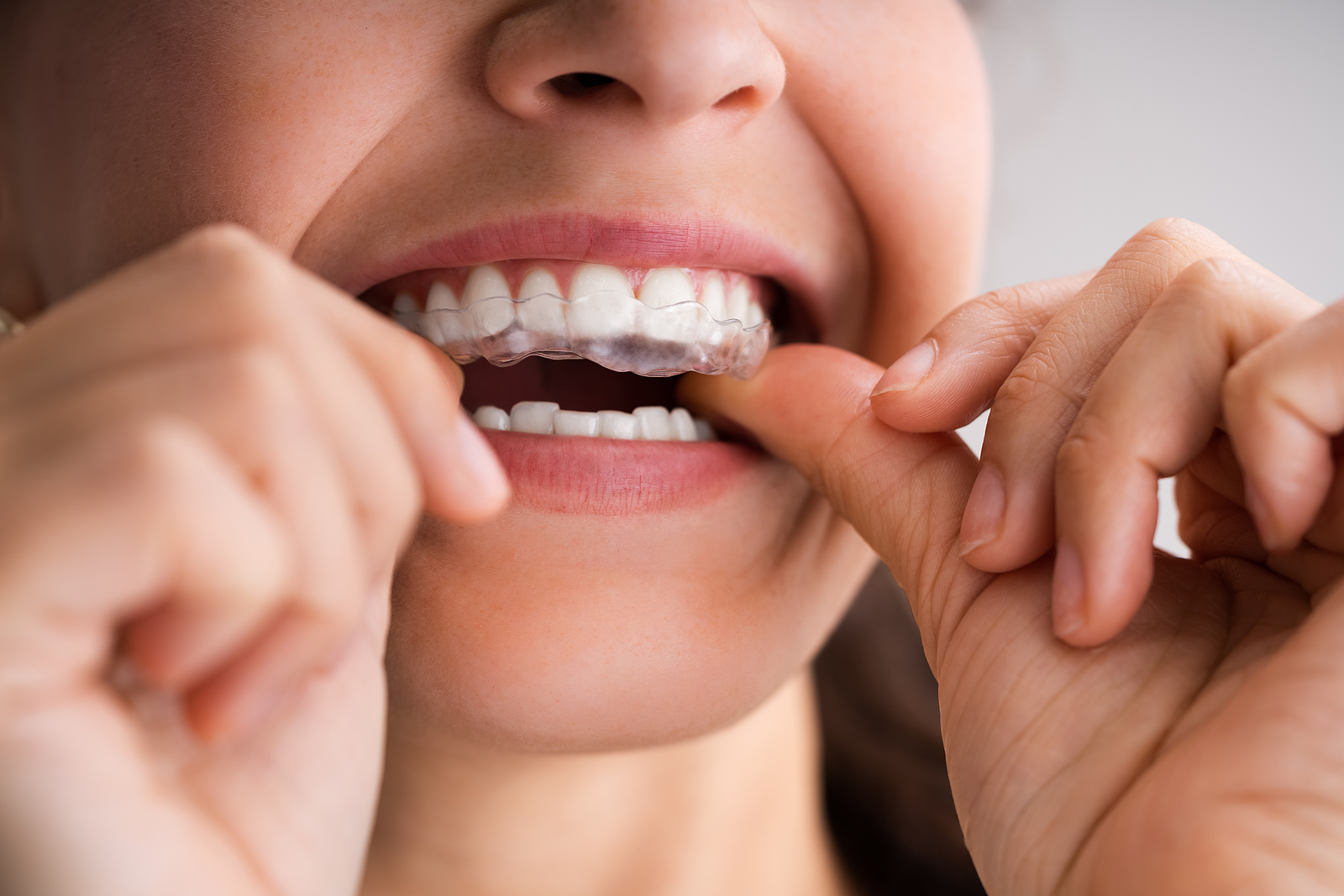 Straighten Your Smile: 5 Dental Conditions Invisalign Aligners Can Address