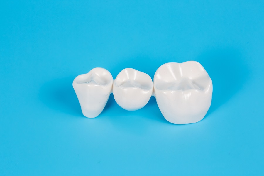 What’s The Difference Between Dental Implants And Bridges?