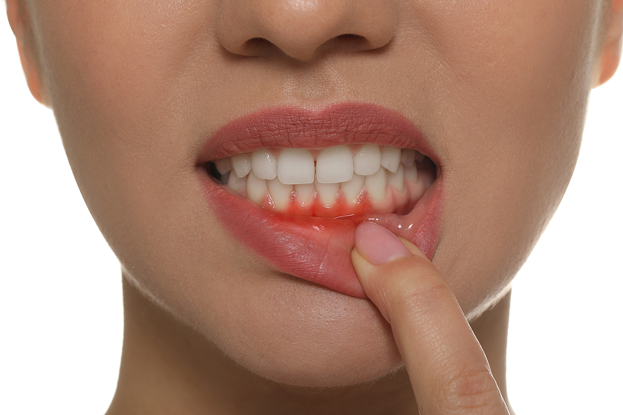 What Are The Risk Factors For Periodontitis?