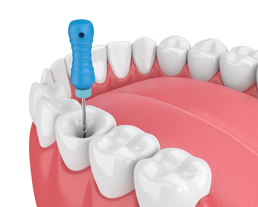 Self Care Tips After Receiving A Root Canal – Recover Quickly & Comfortably